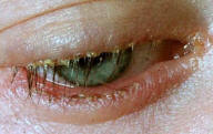 Blepharitis