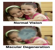 Macular Degeneration